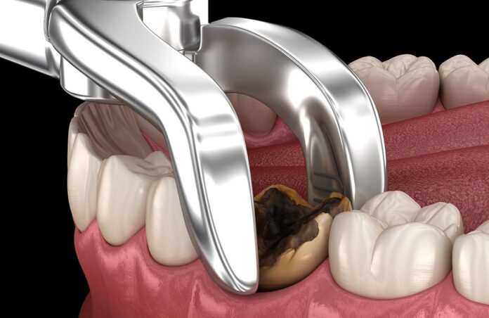 Root Canal Treatment