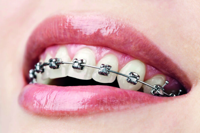 Invisalign Braces London