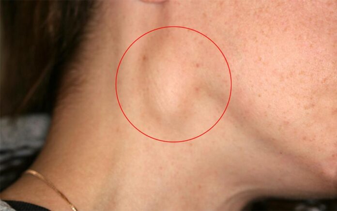 Swollen Lymph Nodes